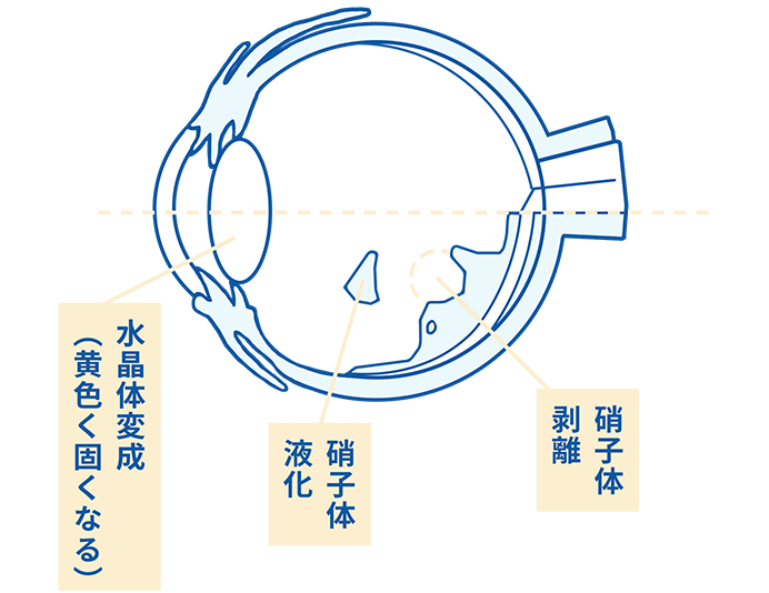 調整力の低下：近くが見えにくくなる（老眼）