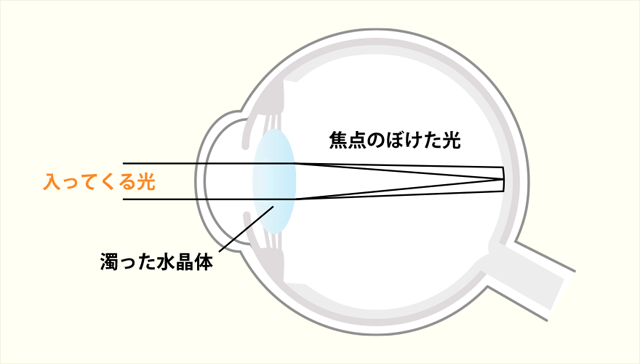 加齢黄斑変性について