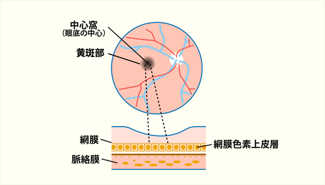 加齢黄斑変性について