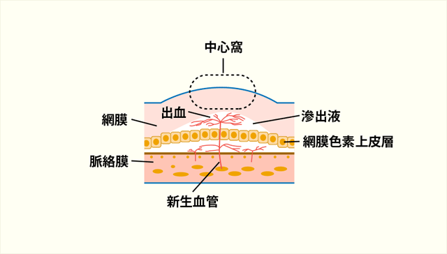 加齢黄斑変性（滲出性加齢黄斑変性）