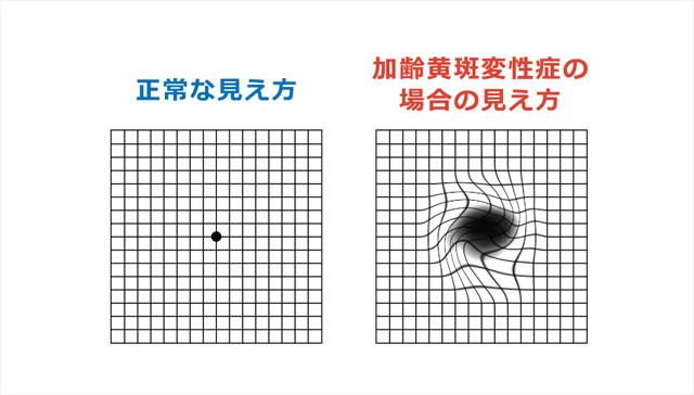 アムスラー検査