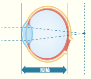 遠視（赤ちゃんの目）