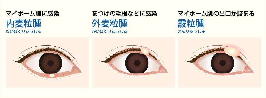 ものもらいの種類