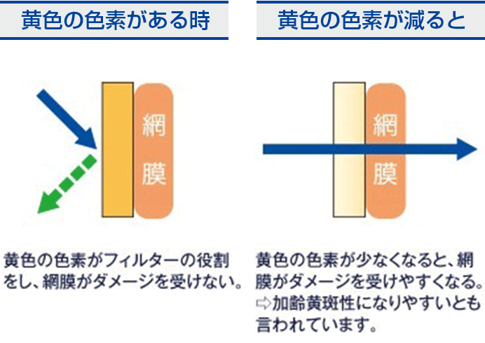 網膜の変化で、加齢黄斑変性になる場合も